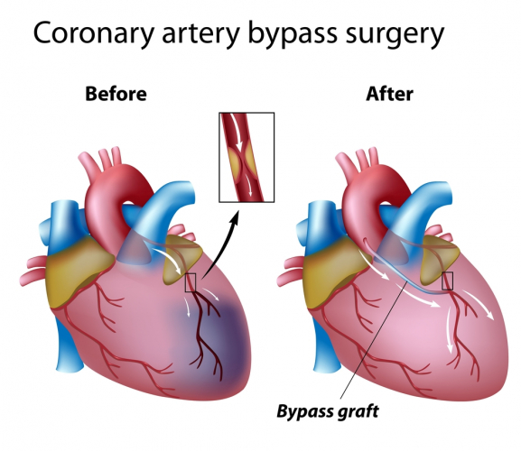 Image of bypass surgery